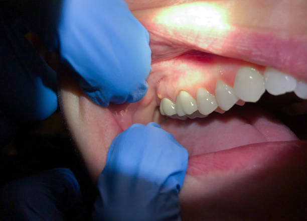 Best Emergency Gum Pain Relief  in Glens Falls, NY